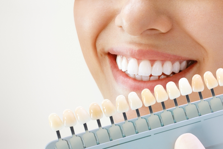 Featured image for “What is the Least Expensive Smile Makeover?”